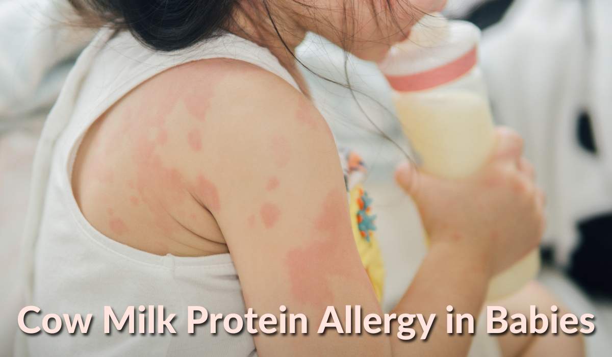 Cow Milk Protein Allergy in Babies